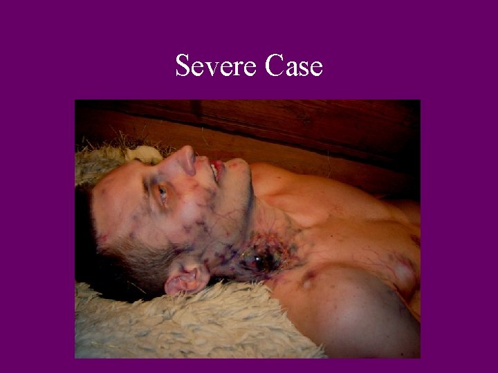 Severe Case 
