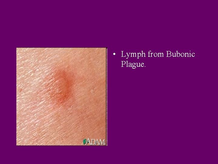  • Lymph from Bubonic Plague. 