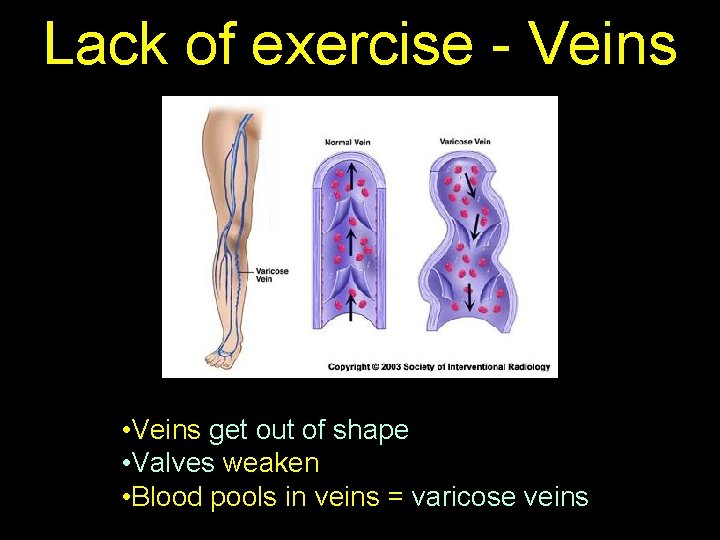 Lack of exercise - Veins • Veins get out of shape • Valves weaken