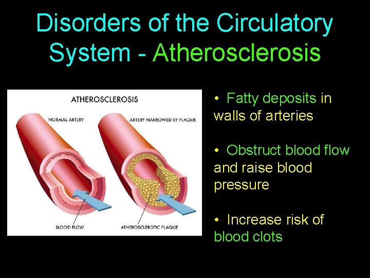 Disorders of the Circulatory System - Atherosclerosis • Fatty deposits in walls of arteries