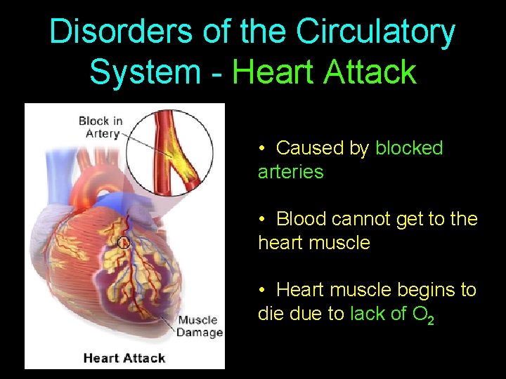 Disorders of the Circulatory System - Heart Attack • Caused by blocked arteries •