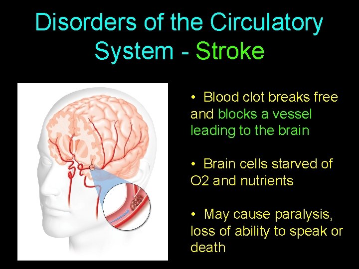Disorders of the Circulatory System - Stroke • Blood clot breaks free and blocks
