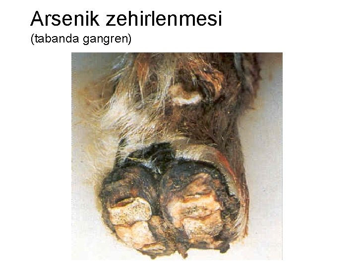 Arsenik zehirlenmesi (tabanda gangren) 