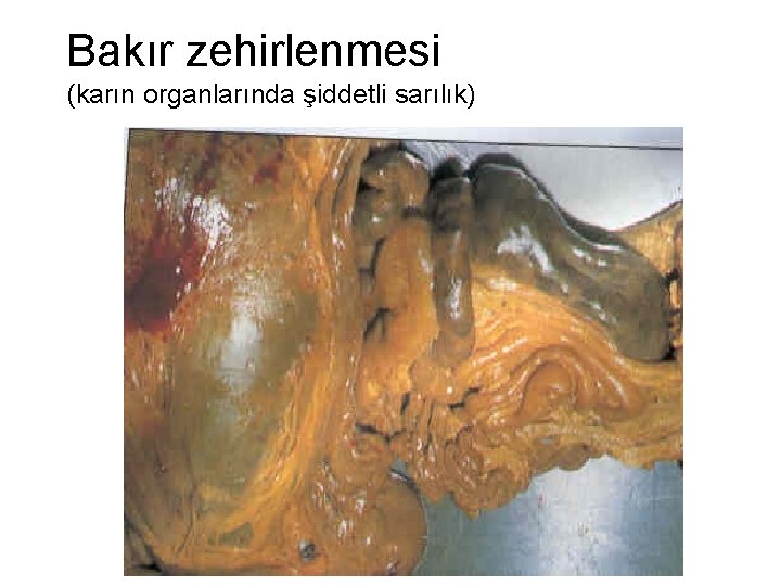 Bakır zehirlenmesi (karın organlarında şiddetli sarılık) 