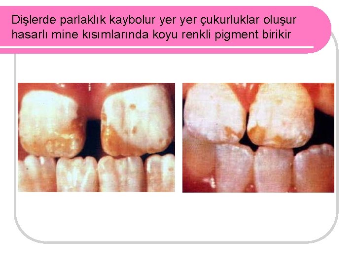 Dişlerde parlaklık kaybolur yer çukurluklar oluşur hasarlı mine kısımlarında koyu renkli pigment birikir 