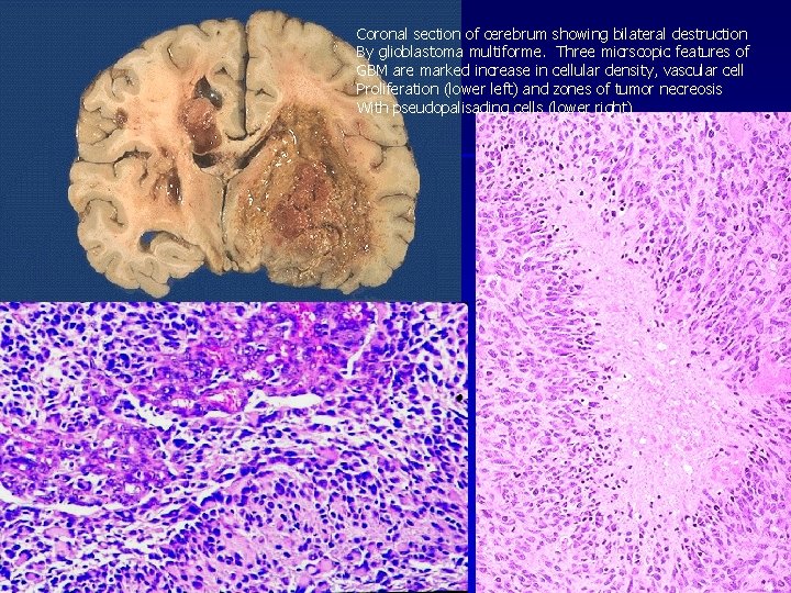 Coronal section of cerebrum showing bilateral destruction By glioblastoma multiforme. Three micrscopic features of