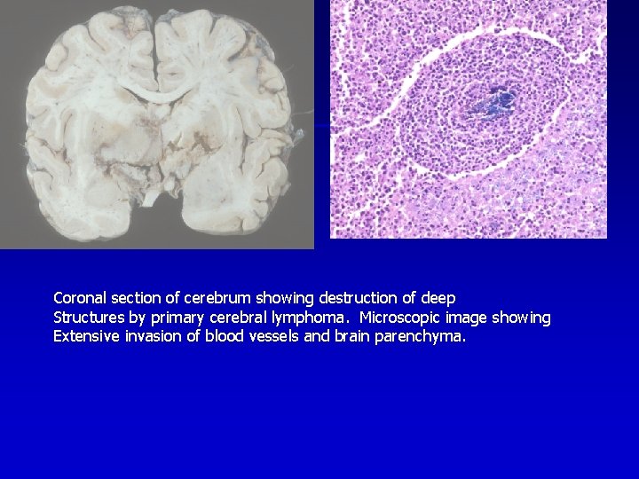 Coronal section of cerebrum showing destruction of deep Structures by primary cerebral lymphoma. Microscopic