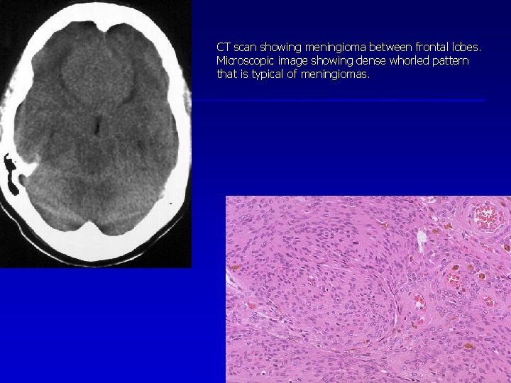CT scan showing meningioma between frontal lobes. Microscopic image showing dense whorled pattern that