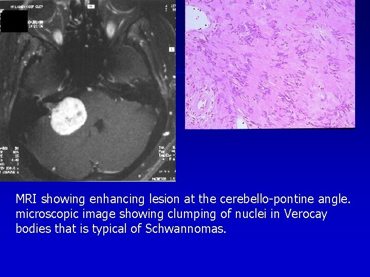 MRI showing enhancing lesion at the cerebello-pontine angle. microscopic image showing clumping of nuclei