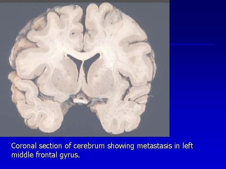 Coronal section of cerebrum showing metastasis in left middle frontal gyrus. 