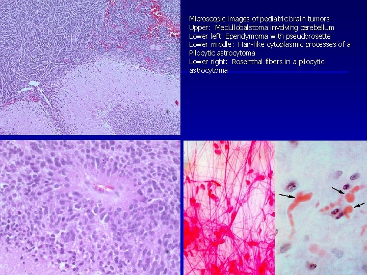 Microscopic images of pediatric brain tumors Upper: Medullobalstoma involving cerebellum Lower left: Ependymoma with