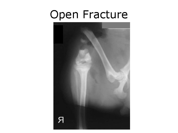 Open Fracture 