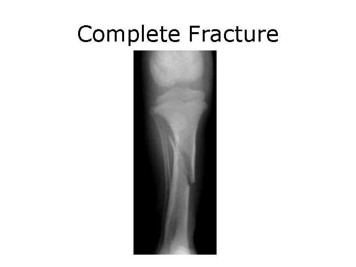 Complete Fracture 