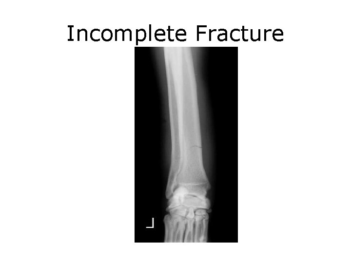 Incomplete Fracture 