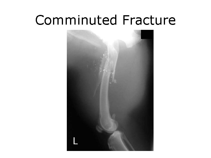 Comminuted Fracture 