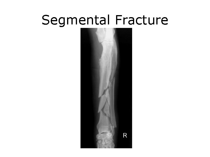 Segmental Fracture 