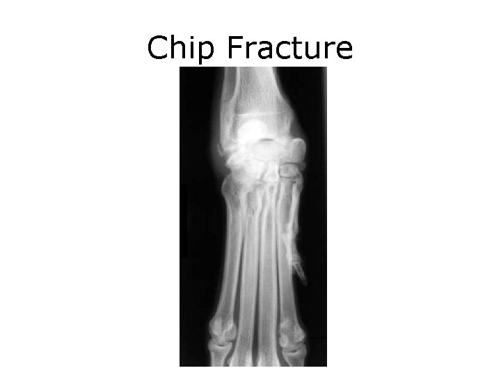 Chip Fracture 