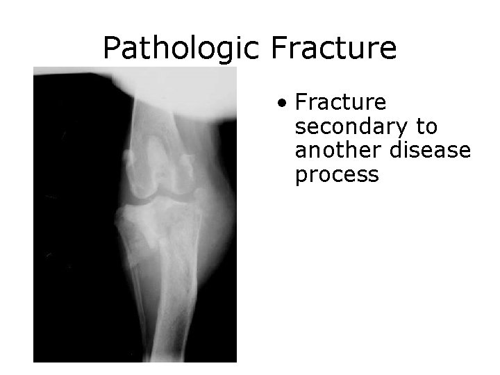 Pathologic Fracture • Fracture secondary to another disease process 