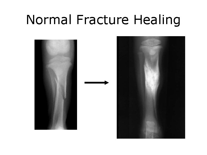 Normal Fracture Healing 