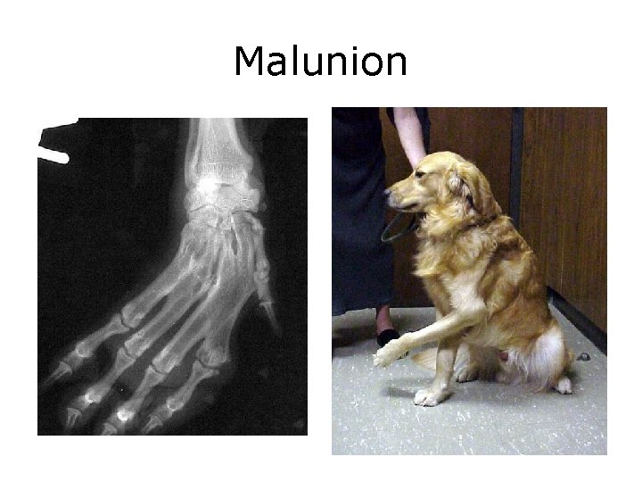 Malunion 