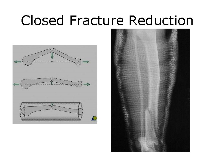 Closed Fracture Reduction 