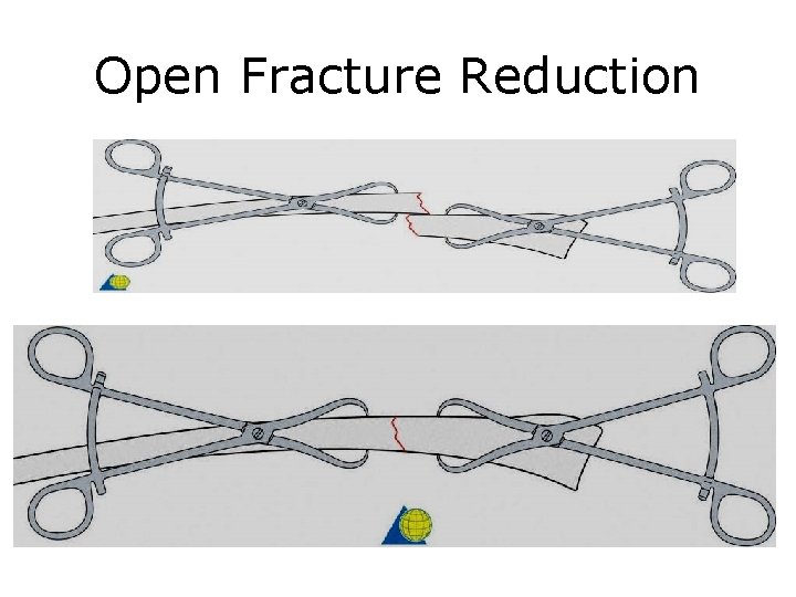 Open Fracture Reduction 