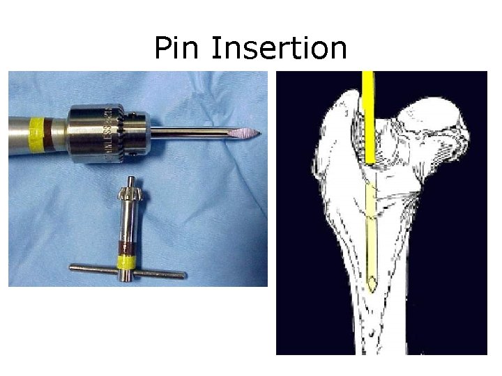 Pin Insertion 