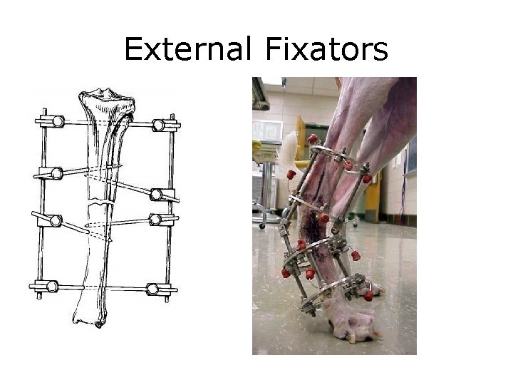 External Fixators 