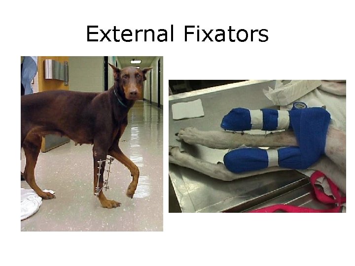 External Fixators 