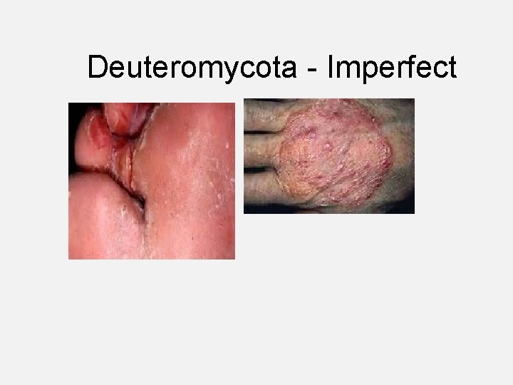 Deuteromycota - Imperfect 