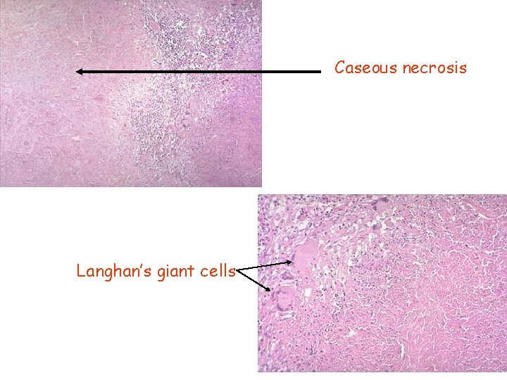 Caseous necrosis Langhan’s giant cells 
