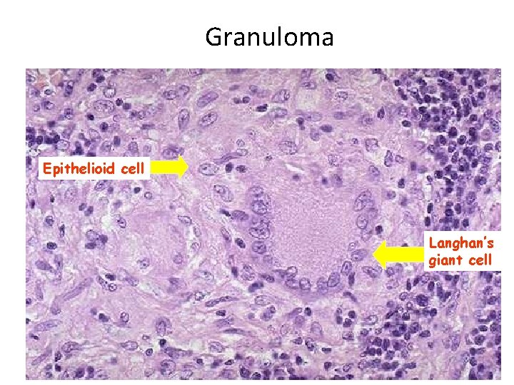 Granuloma Epithelioid cell Langhan’s giant cell 
