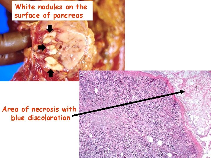 White nodules on the surface of pancreas Area of necrosis with blue discoloration 