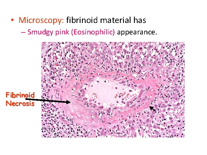  • Microscopy: fibrinoid material has – Smudgy pink (Eosinophilic) appearance. Fibrinoid Necrosis 