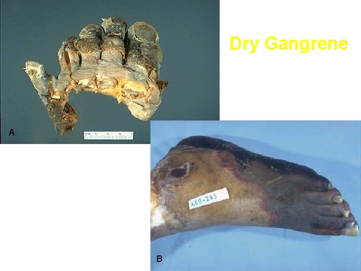 Dry Gangrene A B 