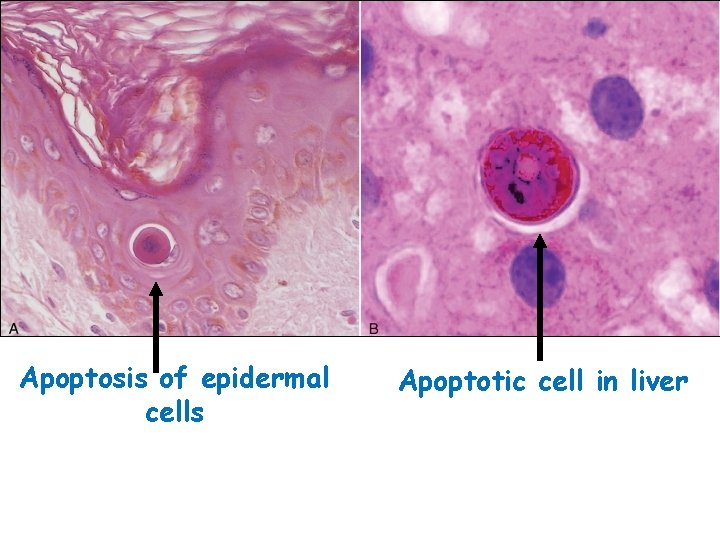 Apoptosis of epidermal cells Apoptotic cell in liver 