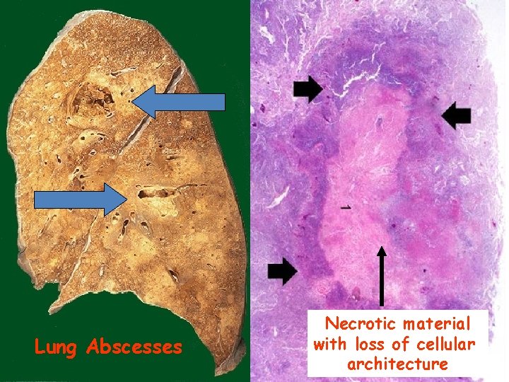 Lung Abscesses Necrotic material with loss of cellular architecture 