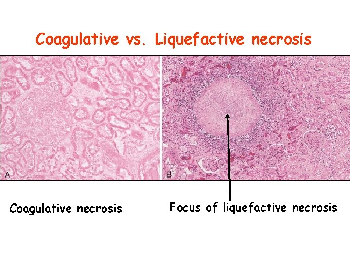Coagulative vs. Liquefactive necrosis Coagulative necrosis Focus of liquefactive necrosis 