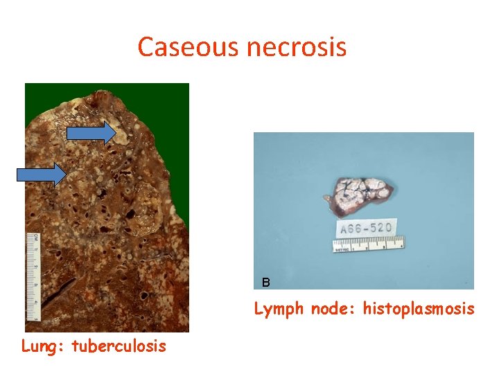 Caseous necrosis B Lymph node: histoplasmosis Lung: tuberculosis 