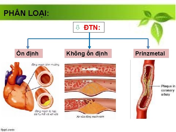 PH N LOẠI: ò ĐTN: Ổn định Không ổn định Prinzmetal 