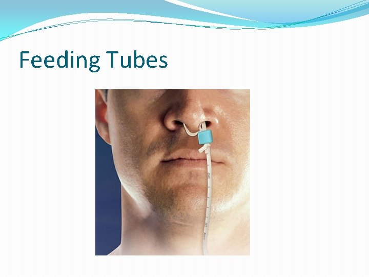 Feeding Tubes 