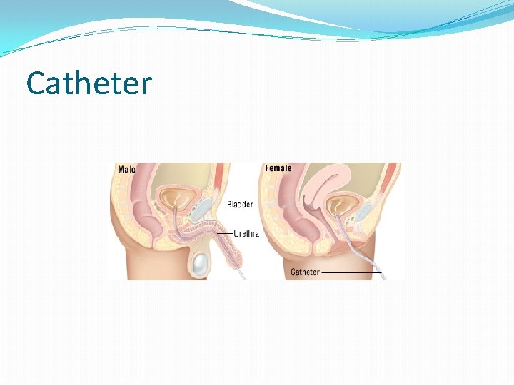 Catheter 