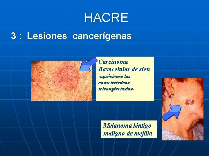 HACRE 3 : Lesiones cancerígenas Carcinoma Basocelular de sien -apréciense las características teleangiectasias- Melanoma