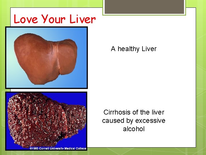Love Your Liver A healthy Liver Cirrhosis of the liver caused by excessive alcohol