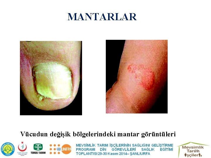 MANTARLAR Vücudun değişik bölgelerindeki mantar görüntüleri 53 