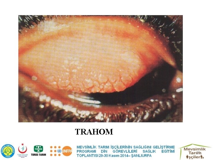 TRAHOM 55 