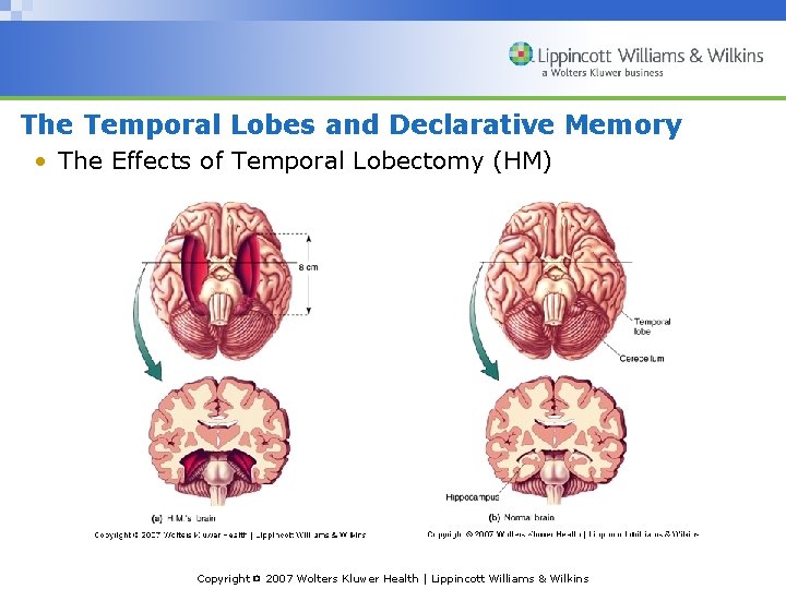 The Temporal Lobes and Declarative Memory • The Effects of Temporal Lobectomy (HM) Copyright