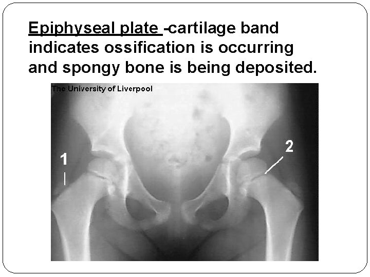 Epiphyseal plate -cartilage band indicates ossification is occurring and spongy bone is being deposited. Epiphyseal plate -cartilage band indicates ossification is occurring and spongy bone is being deposited.