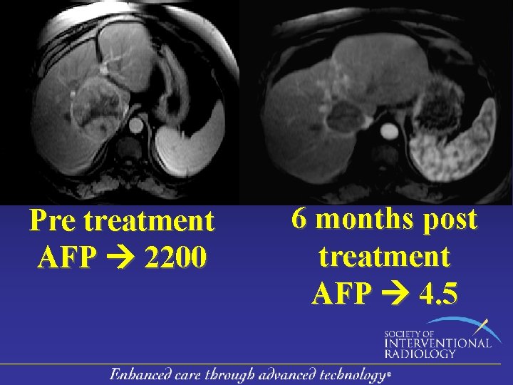 Pre treatment AFP 2200 6 months post treatment AFP 4. 5 