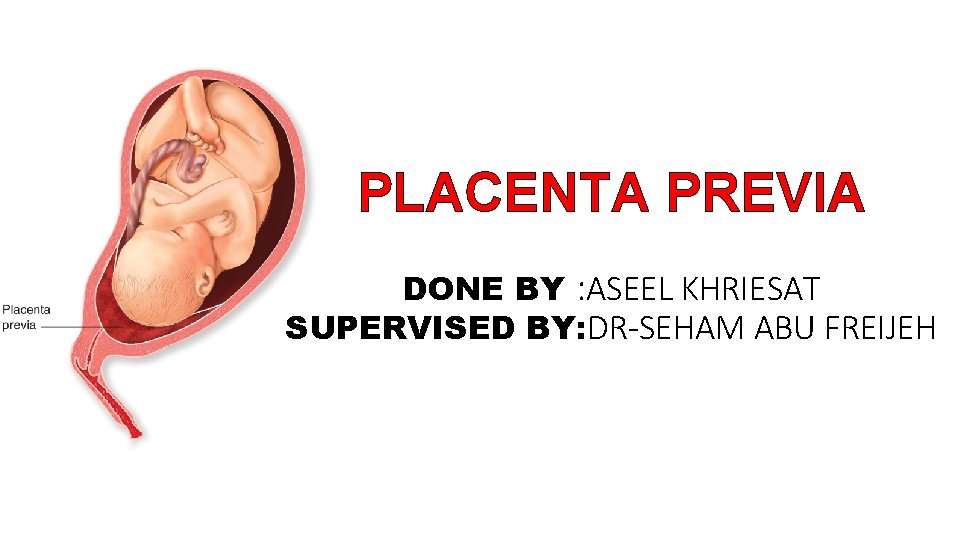 PLACENTA PREVIA DONE BY : ASEEL KHRIESAT SUPERVISED BY: DR-SEHAM ABU FREIJEH 